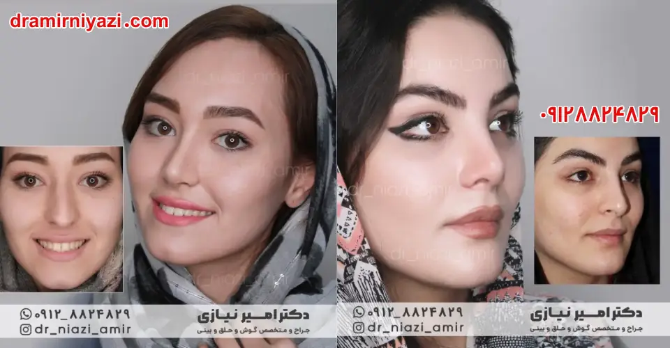 جراحی بینی نچرال