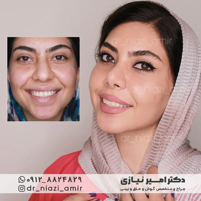 جراحی بینی پهن