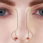 ریویژن جراحی بینی