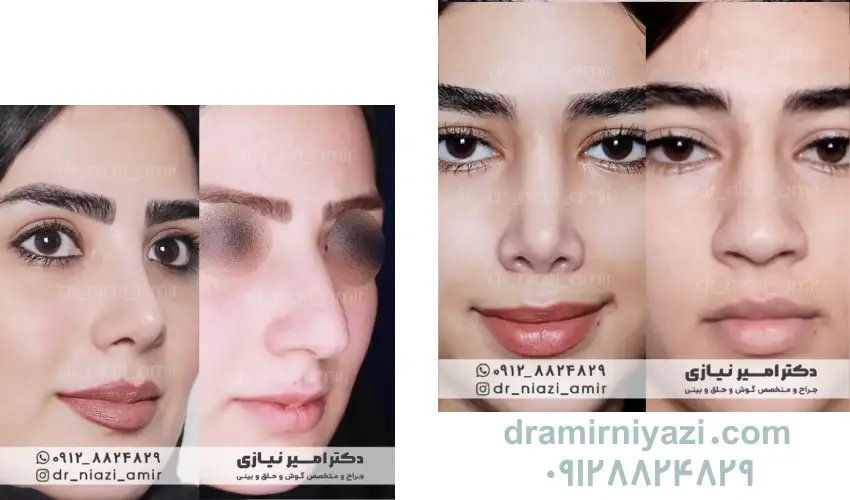 عمل بینی طبیعی
