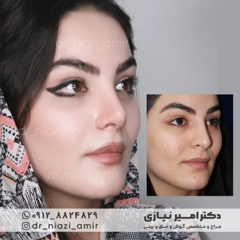 عمل بینی طبیعی
