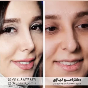 نمونه عمل بینی طبیعی