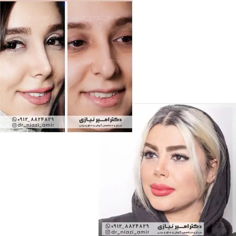 رینوپلاستی بینی غضروفی