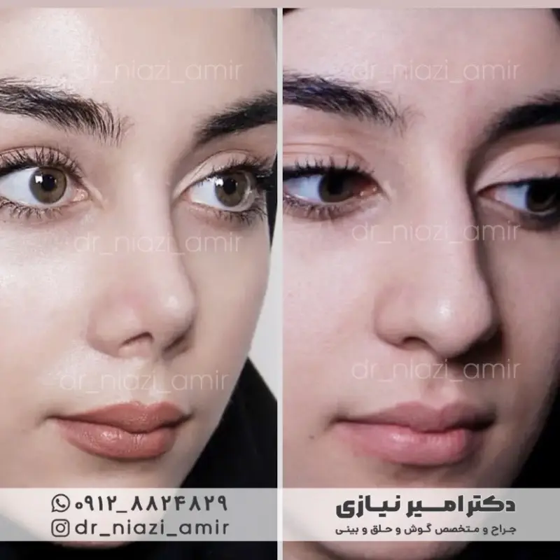 عمل بینی عروسکی