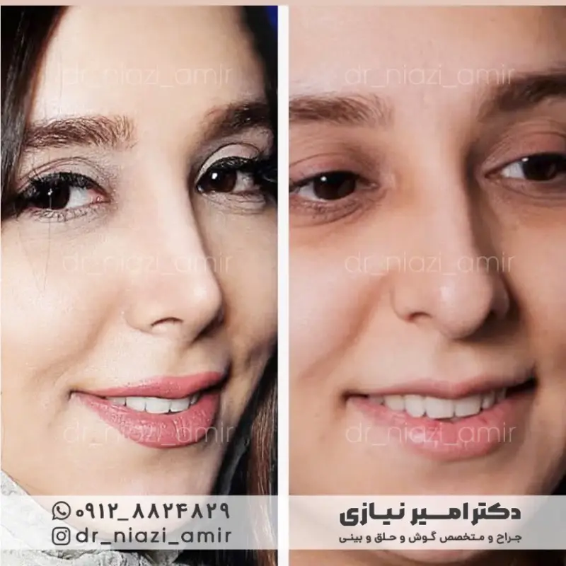 عمل بینی فانتزی