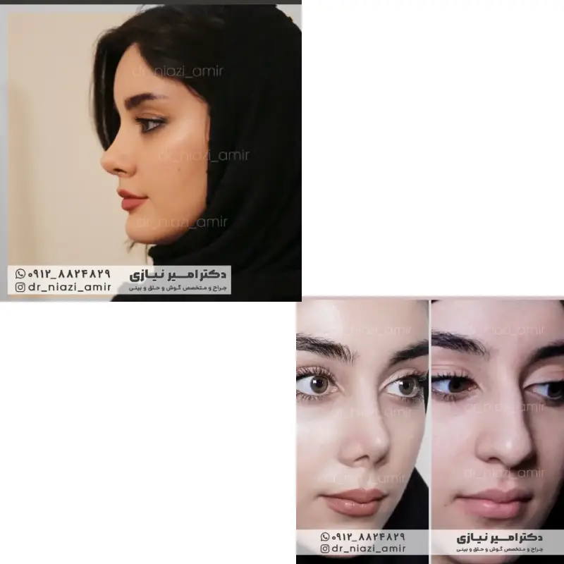 عمل بینی قوزدار