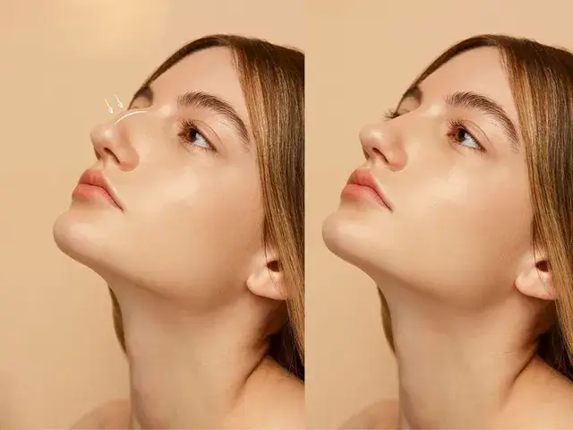 عمل بینی کج