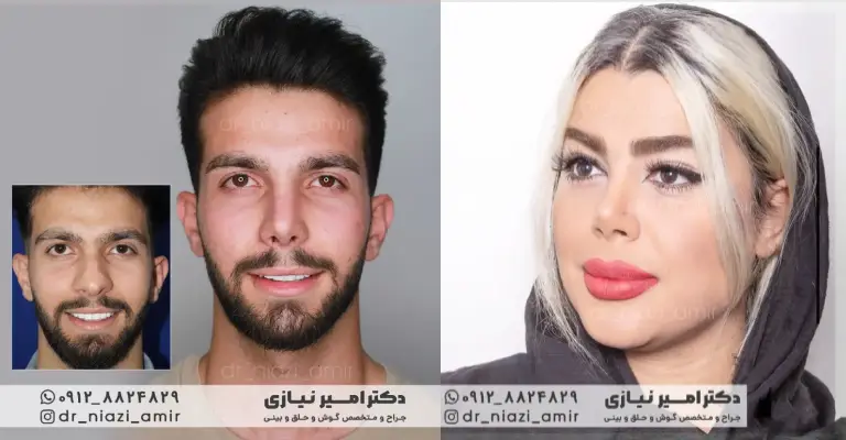عمل بینی گوشتی