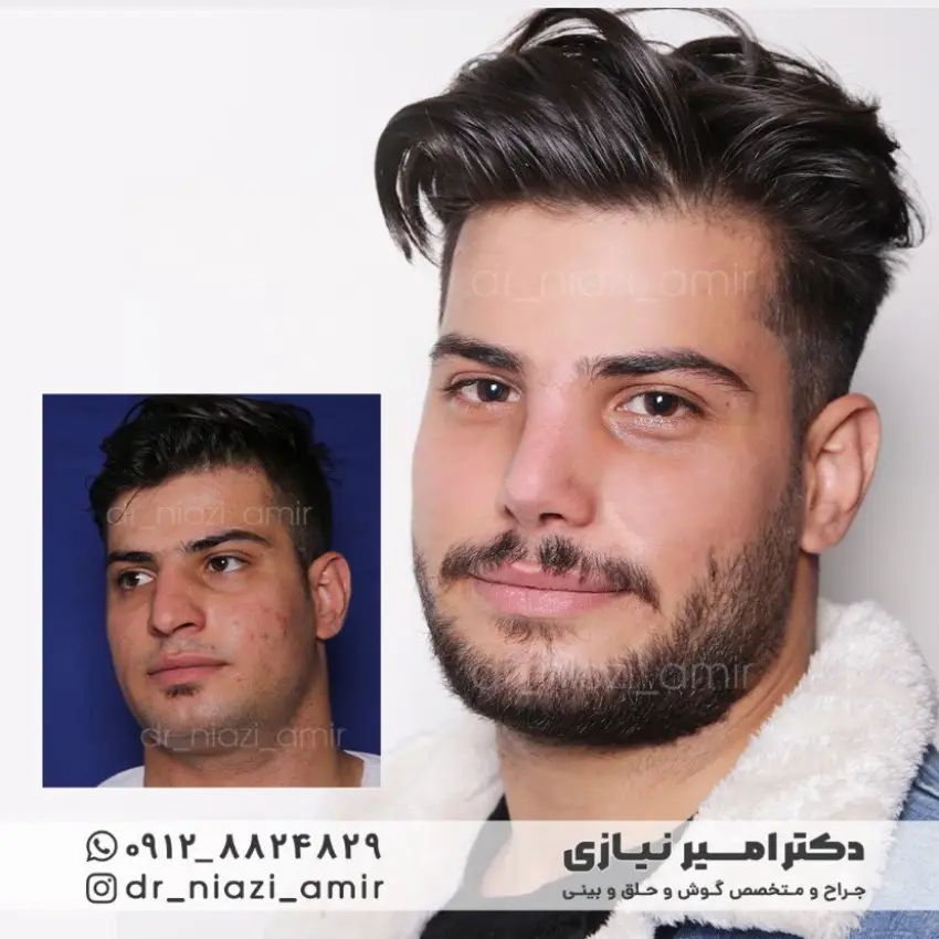 عمل بینی گوشتی آقایان