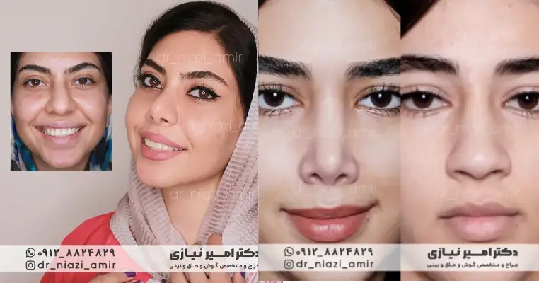 عمل بینی گوشتی زنانه