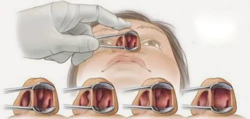 آندوسکوپی بینی