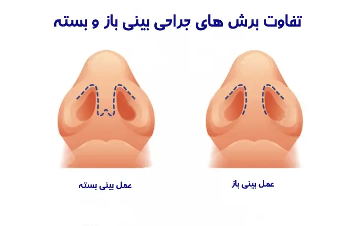 جراحی بینی بسته