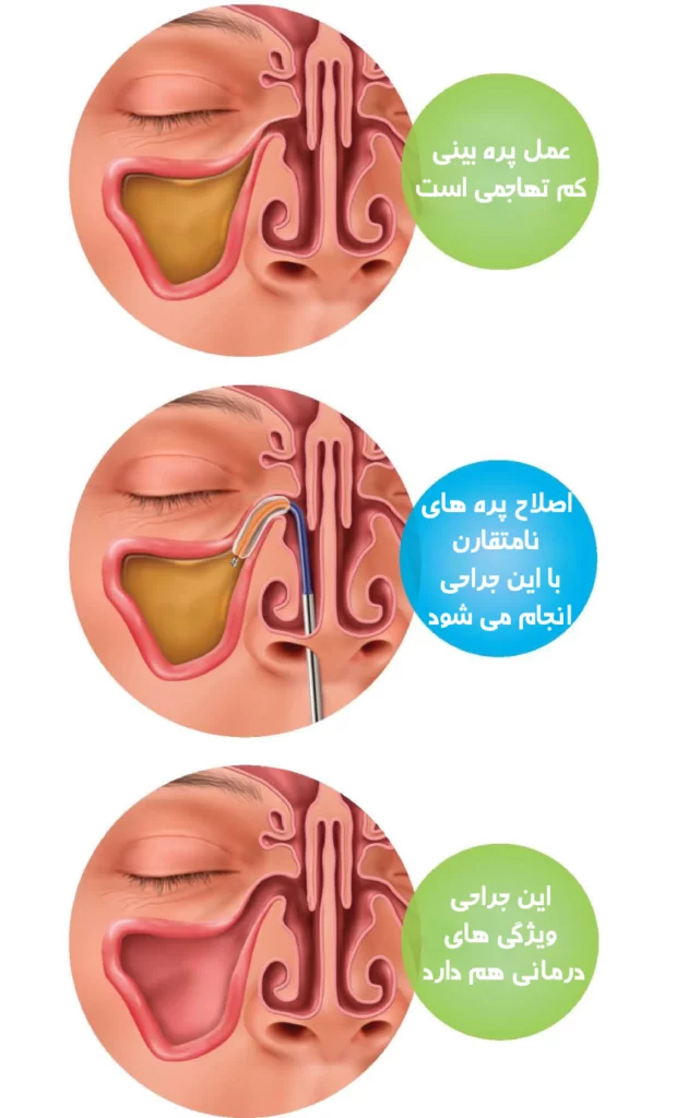 جراحی پره بینی