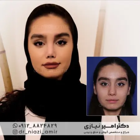 بینی گوشتی دخترانه