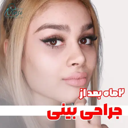 جراحی بینی گوشتی زنانه