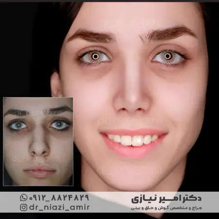 عمل بینی نیمه غضروفی قبل و بعد