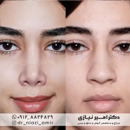 عمل بینی نیمه گوشتی زنانه