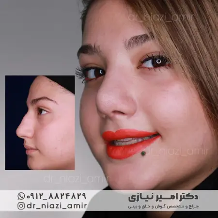 عمل بینی گوشتی دخترانه