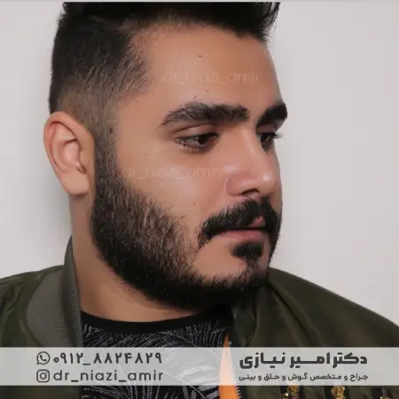 عمل بینی گوشتی مردانه