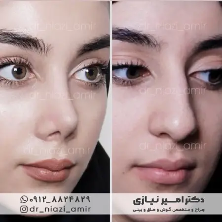 عمل بینی گوشتی نیمه فانتزی