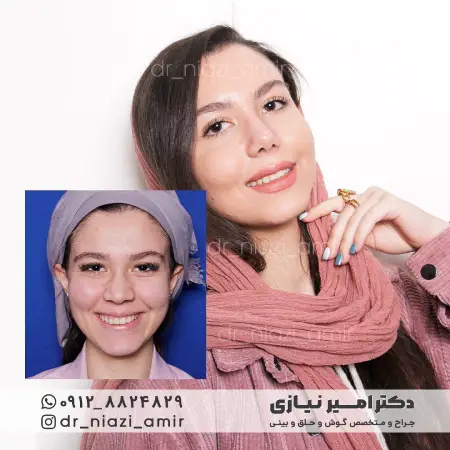 عمل بینی گوشتی پهن دخترانه