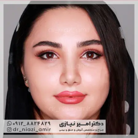 نمونه بعد از جراحی بینی گوشتی