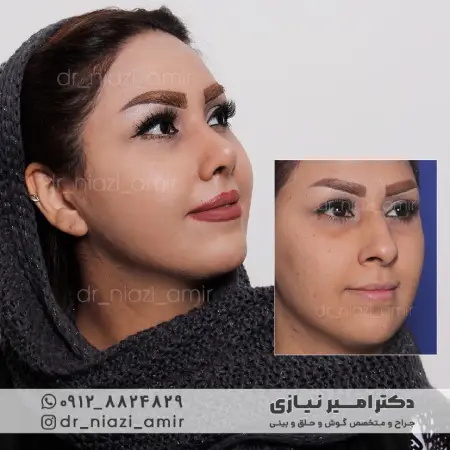 نمونه قبل و بعد عمل بینی نیمه گوشتی