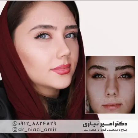 نمونه قبل و بعد عمل بینی گوشتی