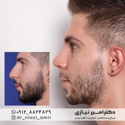 بهترین دکتر عمل بینی مردانه