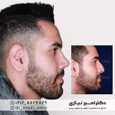 متخصص جراحی بینی مردان