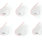 هزینه عمل بینی گوشتی