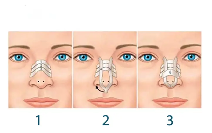 مراحل چسب زدن بینی