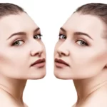 بهترین سبک جراحی بینی