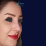 بهترین جراح ترمیم بینی (دکتر امیر نیازی در تهران)
