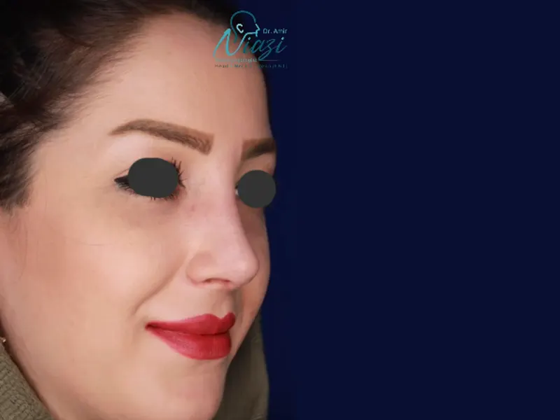 بهترین جراح ترمیم بینی (دکتر امیر نیازی در تهران)