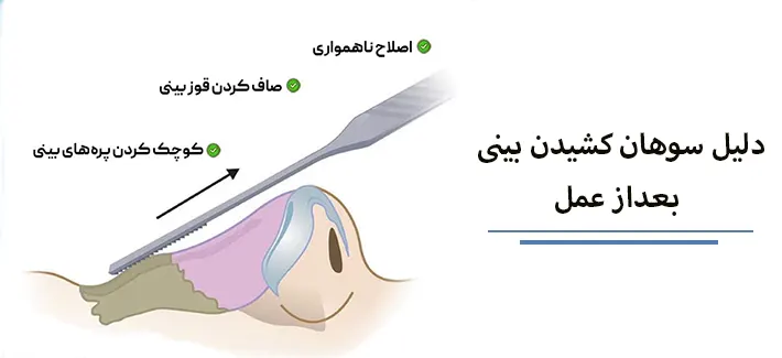 سوهان کشیدن بینی